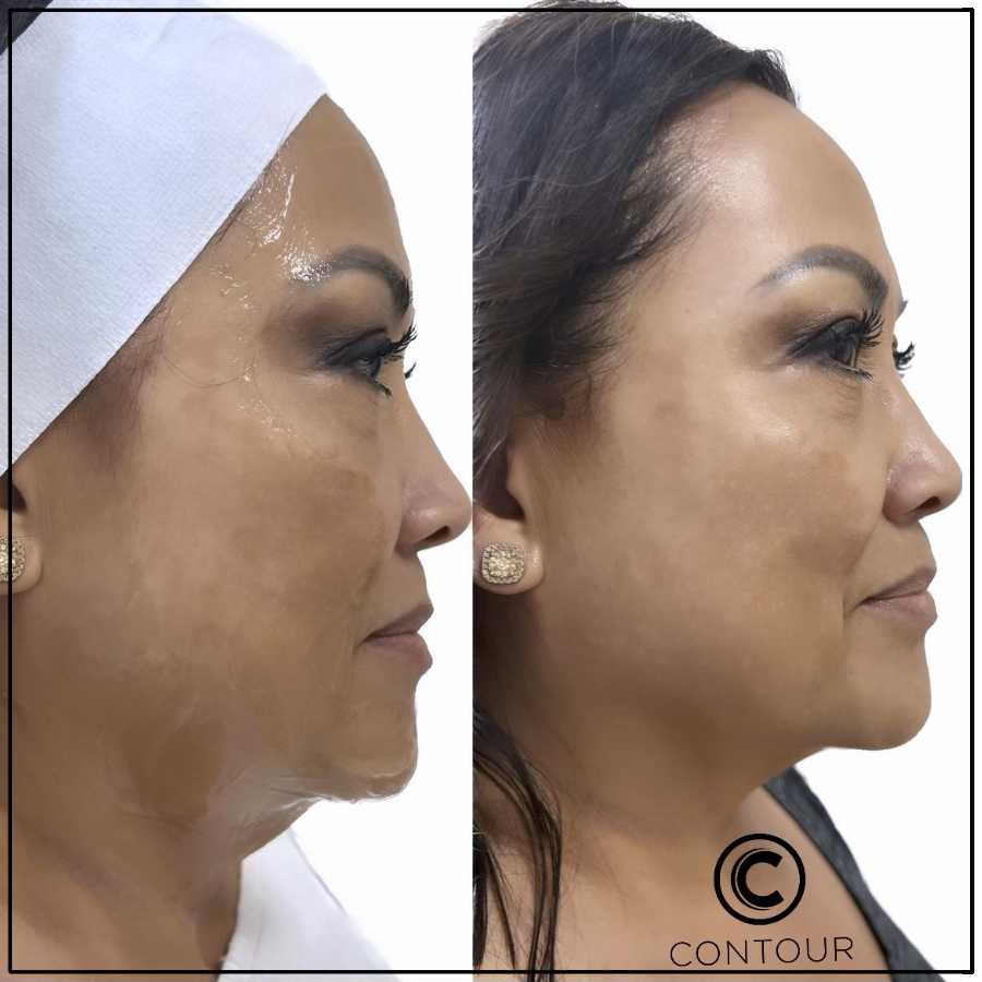 Cryo Facial Before and After in Northridge, Los Angeles, CA Cryo Facial Before and After in Northridge, Los Angeles, CA