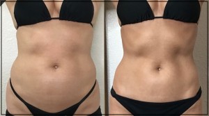 Before & After Photos of CryoSlimming in Northridge, Los Angeles, CA