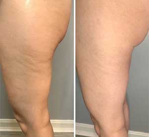 Cryotoning Specialist Near Me in Northridge, Los Angeles, CA Cryotoning Specialist Near Me in Northridge, Los Angeles, CA