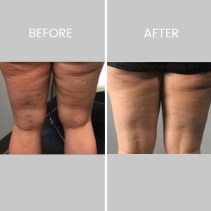 Cryotoning Specialist Near Me in Northridge, Los Angeles, CA Cryotoning Specialist Near Me in Northridge, Los Angeles, CA