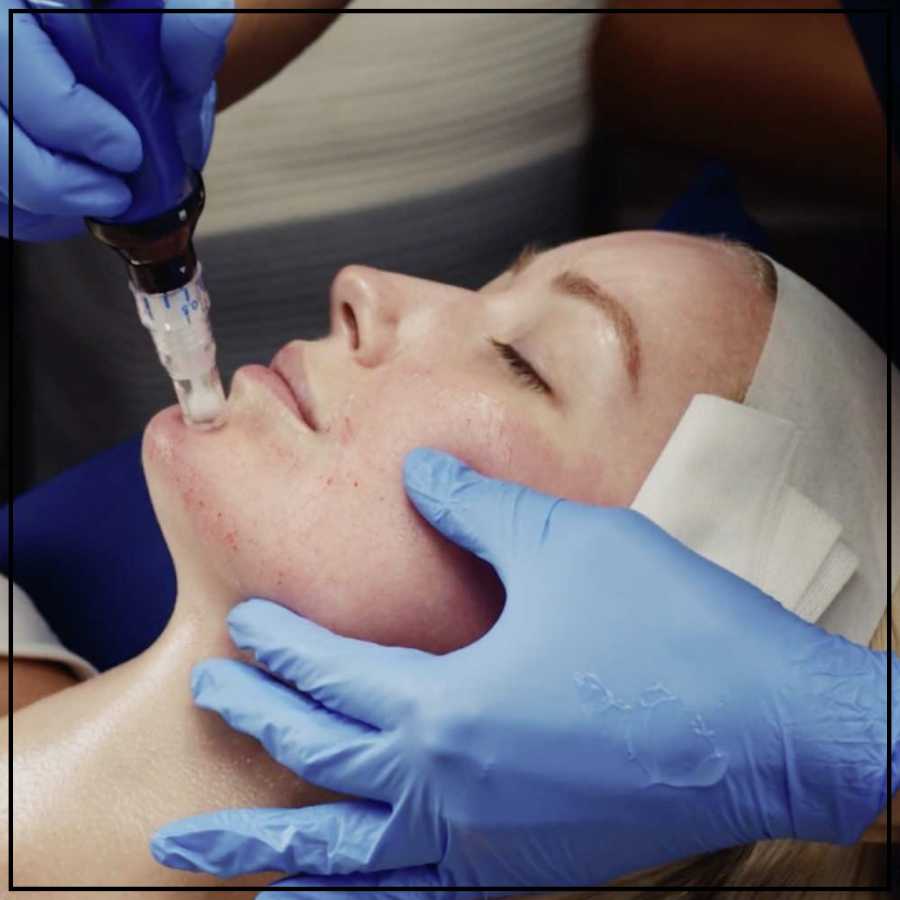 SkinPen Microneedling Treatment Specialist in Northridge, Los Angeles, CA