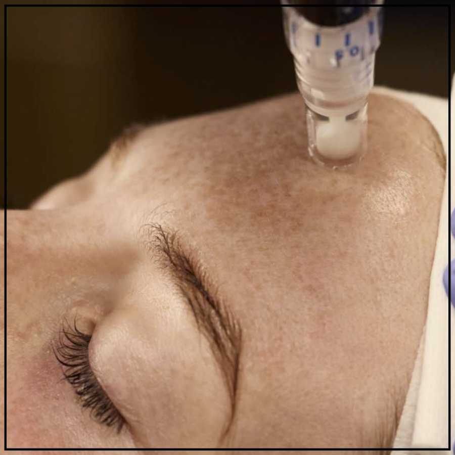 SkinPen Microneedling Treatment Specialist in Northridge, Los Angeles, CA