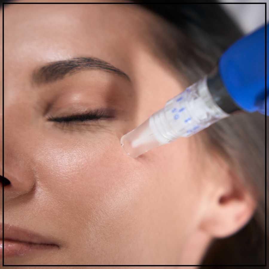 SkinPen Microneedling Treatment Specialist in Northridge, Los Angeles, CA