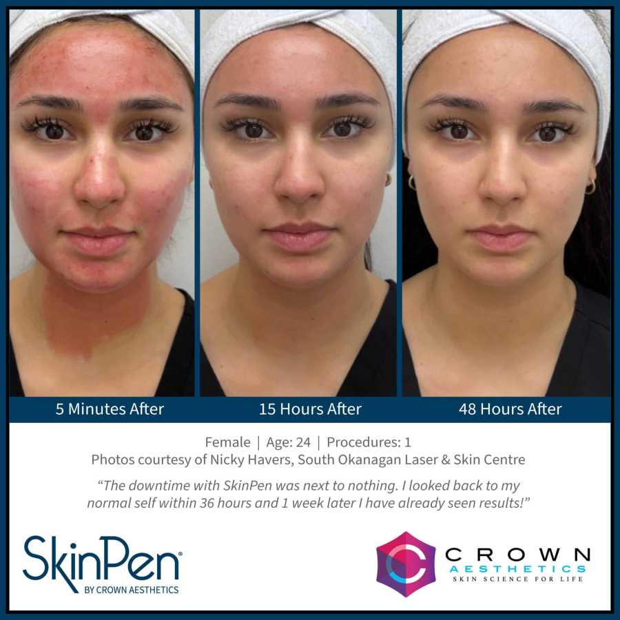 SkinPen Microneedling Treatment Specialist in Northridge, Los Angeles, CA