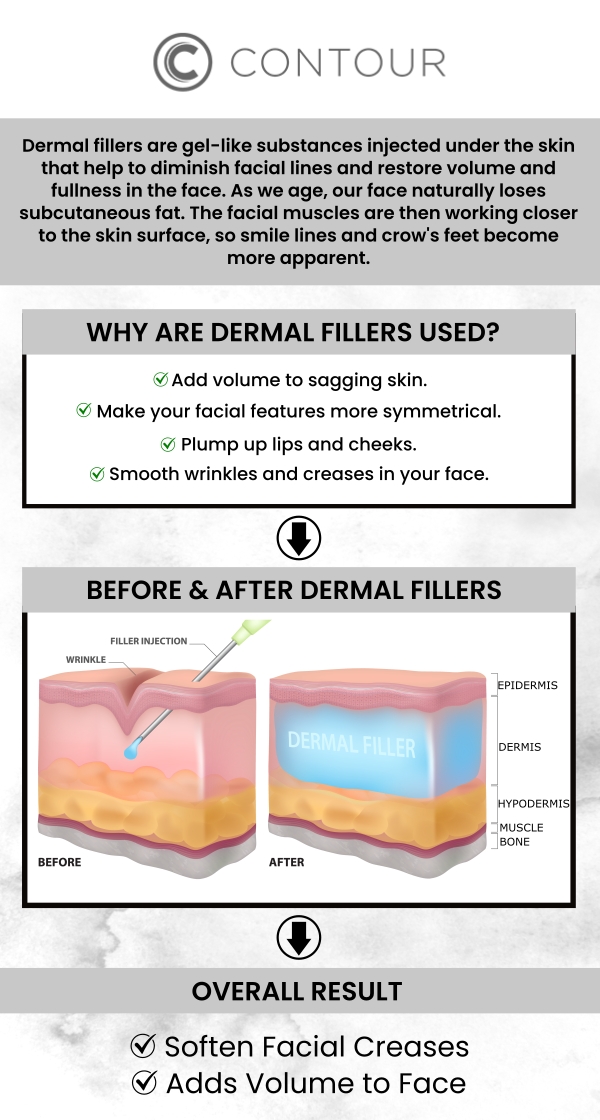 Dermal fillers are used to treat fine lines and deep wrinkles, lessen scars and skin depression, and minimize the effects of aging. Our experienced team at Contour Medical Spa offers dermal fillers (Juvederm), a non-surgical, safe, and effective method to restore a more youthful and revitalized appearance. For more information, contact us or book an appointment online. We are conveniently located at 18641 Devonshire Street Northridge, CA 91324. Dermal fillers are used to treat fine lines and deep wrinkles, lessen scars and skin depression, and minimize the effects of aging. Our experienced team at Contour Medical Spa offers dermal fillers (Juvederm), a non-surgical, safe, and effective method to restore a more youthful and revitalized appearance. For more information, contact us or book an appointment online. We are conveniently located at 18641 Devonshire Street Northridge, CA 91324.