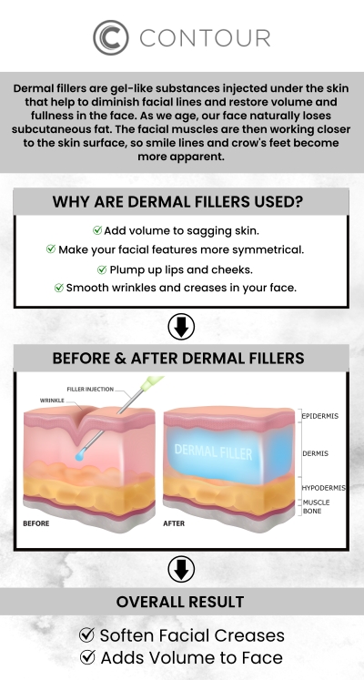 Dermal fillers are used to treat fine lines and deep wrinkles, lessen scars and skin depression, and minimize the effects of aging. Our experienced team at Contour Medical Spa offers dermal fillers (Juvederm), a non-surgical, safe, and effective method to restore a more youthful and revitalized appearance. For more information, contact us or book an appointment online. We are conveniently located at 18641 Devonshire Street Northridge, CA 91324. Dermal fillers are used to treat fine lines and deep wrinkles, lessen scars and skin depression, and minimize the effects of aging. Our experienced team at Contour Medical Spa offers dermal fillers (Juvederm), a non-surgical, safe, and effective method to restore a more youthful and revitalized appearance. For more information, contact us or book an appointment online. We are conveniently located at 18641 Devonshire Street Northridge, CA 91324.